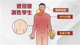 台大,潑酸,醫院,灼傷,清創,失明,阿嬤