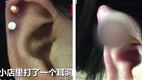 大陸湖南有一名24歲易姓女子，日前到路邊小店打耳洞，不料到家後，耳朵腫得如一顆鵪鶉蛋大，易女緊急就醫進行手術後，所幸沒有大礙（圖／翻攝自秒拍）