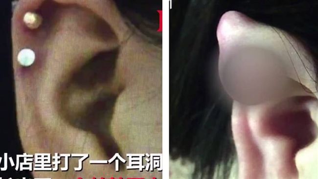 女到路邊小店打耳洞　耳朵腫如鵪鶉蛋