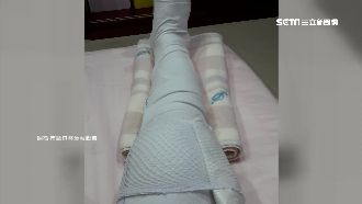 美魔女議員被車撞　右膝骨折需休兩月