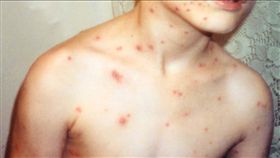 校園水痘群聚事件國中以上年齡層有逐漸增加趨勢，學校、家長都應該提高警覺！
圖／翻攝維基百科
