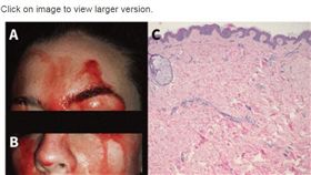 義大利一名21歲少女罹患罕見的「血汗症」（圖／翻攝自《加拿大醫學協會期刊CMAJ》）