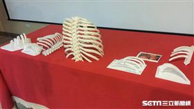 三軍總醫院胸腔外科醫療團隊是國內首次針對病人各種不同肋骨骨折型式，利用3D列印技術在手術前進行個人化設計，有助手術傷口小、減少住院日。（圖／記者楊晴雯攝）