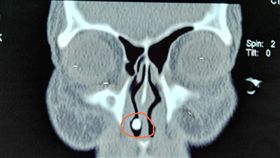 大陸,牙齒,鼻腔(騰訊 http://hn.qq.com/a/20171026/015899.htm)