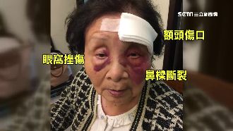 落差2.5公分！8旬婦慘摔滿臉血