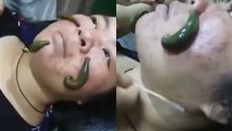 愛美不要命？4條肥水蛭爬滿痘痘臉