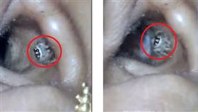 印度有位女子拉克什米（Lekshmi L）半夜常因頭痛、耳痛，讓她徹夜難眠，女子就醫後，竟發現耳朵裡有隻大蜘蛛（圖／翻攝自秒拍）