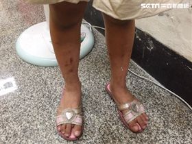 女童雙腳傷痕累累