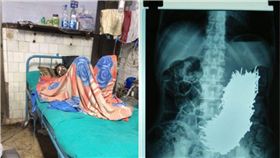 印度,鐵釘,異食,吞嚥異物,Pradip Kumar Dhali　圖／翻攝自鏡報