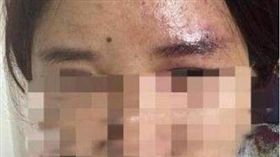 中國大陸,注射,玻尿酸,視力,模糊,失明,針筒（圖／翻攝自微博）https://www.weibo.com/ttarticle/p/show?id=2309351000444141656273214752