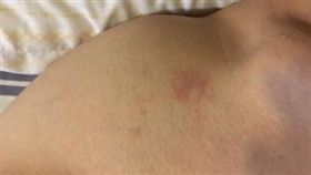 男友教召5天　肩膀多了像「草莓」的印記／爆廢公社