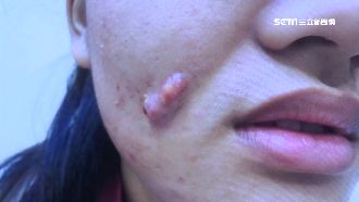 粉刺機輕鬆除粉刺？女爛痘惡化爆粉瘤