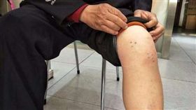 水蛭鑽左腿3年多…陸男痛到不能工作　最大竟變這麼長！ 圖翻攝自新浪網 http://news.sina.com.cn/s/qw/2017-11-13/doc-ifynstfh7380848.shtml