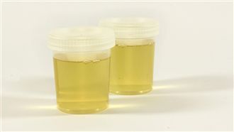 尿尿有泡…醫示警：像「啤酒泡沫」是異常