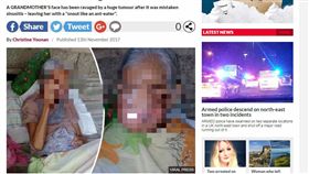 菲律賓,伊迪莎,腫瘤,倒生性乳頭瘤(dailystar https://www.dailystar.co.uk/news/world-news/659769/Tumour-Philippines-health-grandma-photos-pains)