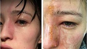 英國,精油,蒸氣,薰香機,芳香,毀容,化學灼傷,潰爛　圖／翻攝自鏡報