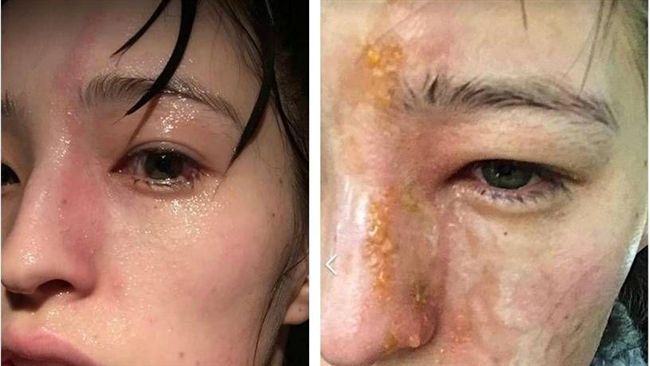 女子被精油機噴到臉　隔天竟意外毀容
