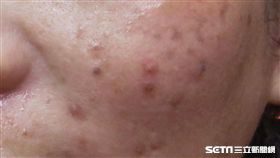 ▲李婦使用過期保養品，肌膚出現過敏情形。（圖／醫師黃雍宗提供）