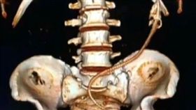 江西南昌男子體內有鱔魚／看看新聞