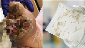 蛆蟲療法,糖尿病,截肢,larval therapy,幼蟲療法,James Murray,英國,林肯郡,腳底板,燙傷　組合圖／翻攝自每日郵報