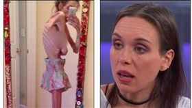 美國紐約有一名28歲女子羅達絲（Stephanie Rodas），她童年因遭同儕霸凌，罹患厭食症，體重曾一度只剩55英鎊（約25公斤），甚至還差點死亡。目前羅達絲正接受治療，盼能找到解決厭食症的方法。（圖／翻攝自每日郵報）