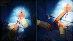 菊花,肛門,象牙,走私,急診室,手術,案例,醫療,Medicaltalks　圖／翻攝自Medicaltalks IG