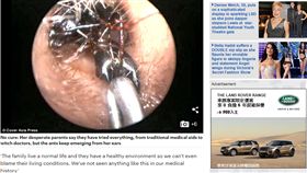 印度,耳朵,螞蟻(http://www.dailymail.co.uk/news/article-3430080/Indian-girl-ONE-THOUSAND-giant-ants-removed-ears-insects-got-inside-began-breeding-ten-emerging-DAY.html)