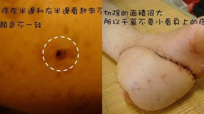 小痣成「衛星痣」　她母切半腳險喪命