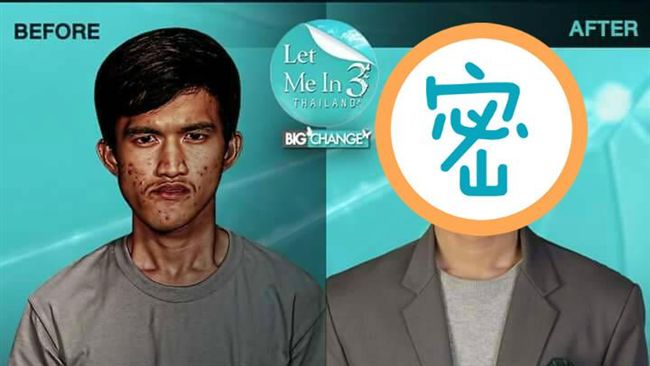 天生下巴畸形！泰男赴韓改造秒變型男