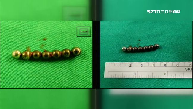 9歲童吞7顆巴克球　卡腸穿孔險致命