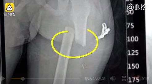 不爽6歲童走太慢　狠父竟踹斷他大腿