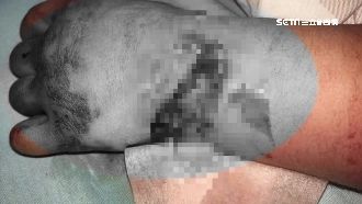 5歲女童遭電梯咬手　伸指肌斷裂重傷