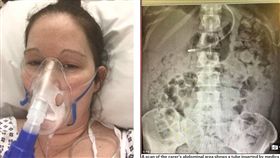 英國布里斯托有一名女子約曼（Kelly Yeoman）日前動了「微創手術」，導致她的腸道受損，現在她只要一進食，糞便就會從她口中吐出。目前她的家人正在籌資金，希望能盡速將她送到倫敦的私人醫院接受治療。（圖／翻攝自每日郵報）