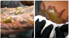  男子刺青感染。（圖／翻攝自Dr Medical Cases臉書） https://www.facebook.com/DrMedicalCases/videos/926389194174780/