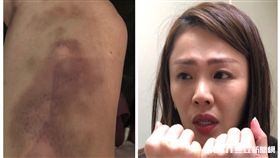 李婉鈺瘀青照 本人提供