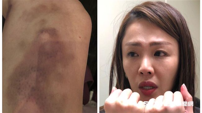 PO瘀青照控警打人！李婉鈺求沉澱