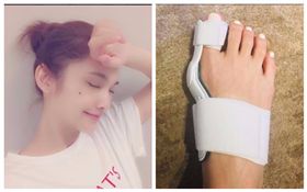 楊丞琳拇指外翻戴矯正器　職業病太傷