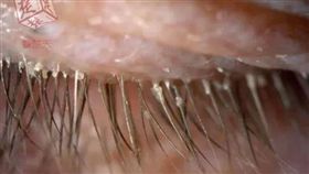 中國大陸,大媽,枕頭套,睫毛,蟎蟲,眼睛（圖／翻攝自新浪網）http://news.sina.com.cn/o/2017-12-01/doc-ifyphtze3082007.shtml