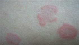 血管炎
翻攝網路