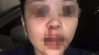 只為一本護照！惡夫聯手弟暴打分居妻