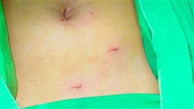 割盲腸傷口,闌尾 翻攝新浪網