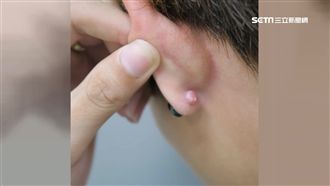 男大生穿耳洞　耳針竟被肉芽包起來