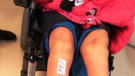 女遭性侵…警誤認女屍丟棄害截肢失明