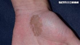 成大醫院,皮膚部,楊省三,黴菌感染,惡性腫瘤,,黑癬