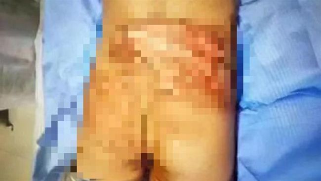 被5同學霸凌…小學生下體遭燙爛滲血