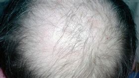 禿頭圖自維基百科