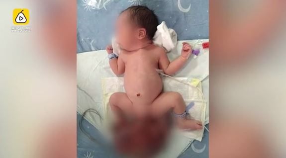 男嬰屁股生出「兄弟」　體重竟都一樣