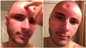 曬傷,光頭,防曬,除草／Cade Huckabay推特‏