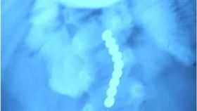 磁力球,男童,誤食,大陸,江西,糖果　圖／翻攝自微博