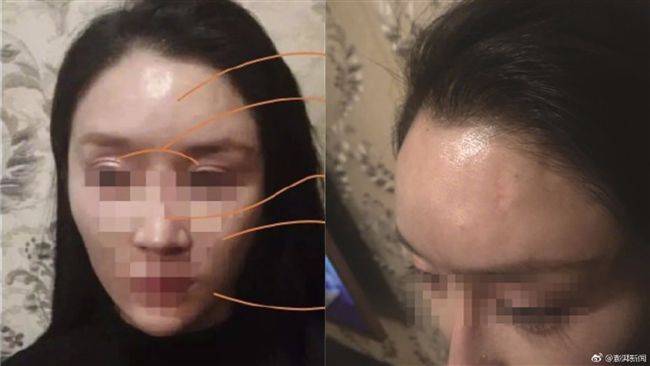 22萬整成網美臉　被酒杯砸中臉凹了